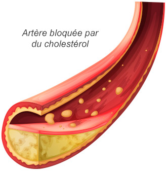 Artère bloquée par du cholestérol