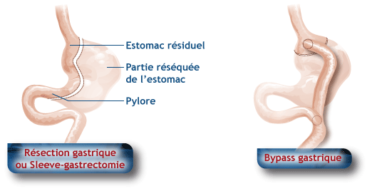 Chirurgie bariatrique - estomac