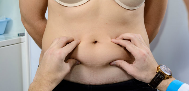 Obésité, quel est l’intérêt de l’abdominoplastie ?